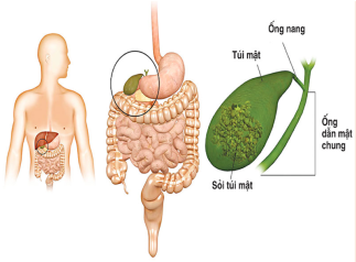 Sỏi túi mật: khi nào cần phẫu thuật