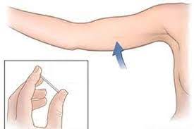 Thông tin cần biết về Cấy que tránh thai