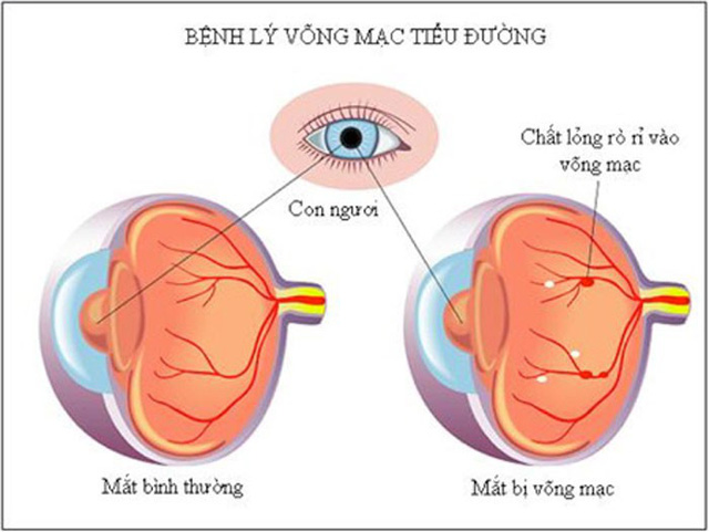 Bệnh võng mạc đái tháo đường: nguyên nhân, triệu chứng, điều trị