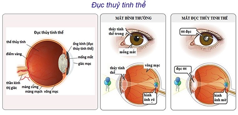 Đục thủy tinh thể