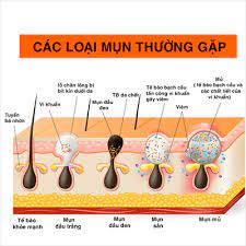Mụn trứng cá