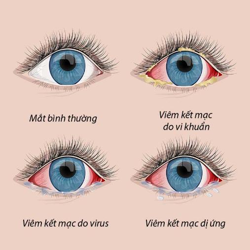 Viêm kết mạc: nguyên nhân, triệu chứng, điều trị.