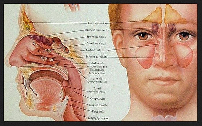 Những điều cần biết về viêm xoang mãn tính