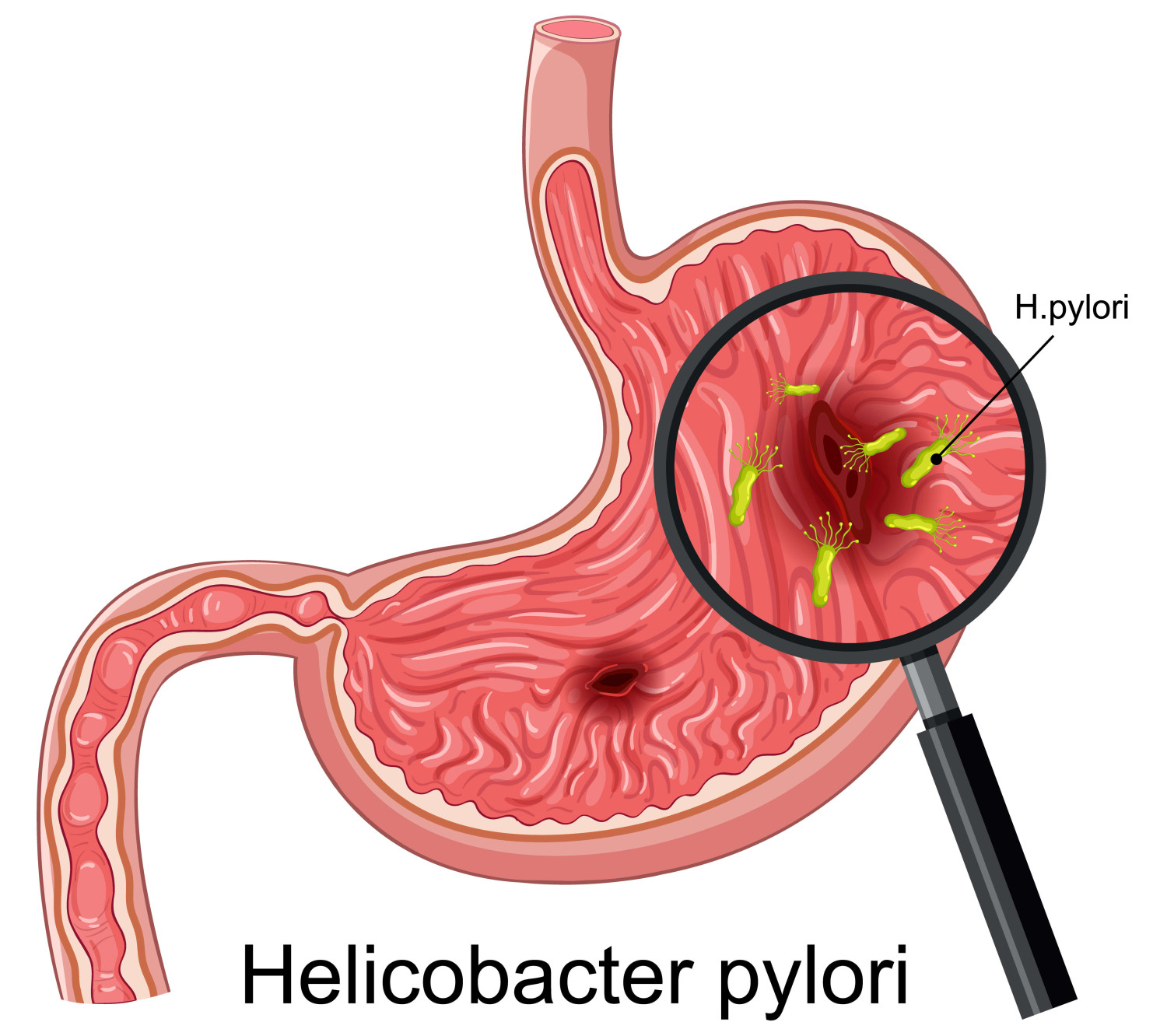 PHÁT HIỆN & ĐIỀU TRỊ SỚM HELICOBACTER PYLORI (H. PYLORI) GIÚP GIẢM NGUY CƠ TIẾN TRIỂN UNG THƯ DẠ DÀY