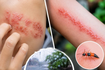 NỔI MỤN NƯỚC, BỎNG RÁT DA: ZONA HAY KIẾN BA KHOANG?