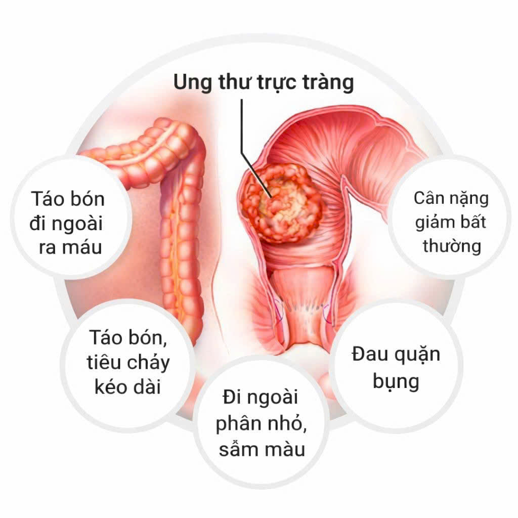 DẤU HIỆU CẢNH BÁO SỚM UNG THƯ ĐẠI TRỰC TRÀNG